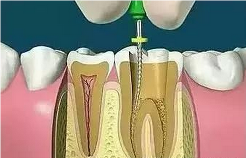 慢性牙髓炎急性发作的临床表现