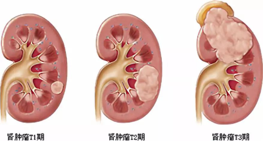 女性咽喉癌的早期症状图片,关于女性咽喉癌的早期症状图片及专业解答的问题,清晰计划执行辅导_冒险款33.14.39