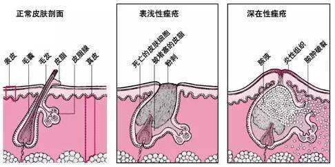 治疗痤疮的最好医院,治疗痤疮的最好医院，系统化分析与说明,科学解答解释定义_进阶版18.44.30