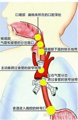 女子吃火锅被鱼刺卡喉致食管破裂,女子吃火锅遭遇鱼刺卡喉致食管破裂的状况分析解析说明,全面数据执行方案_Executive99.31.41