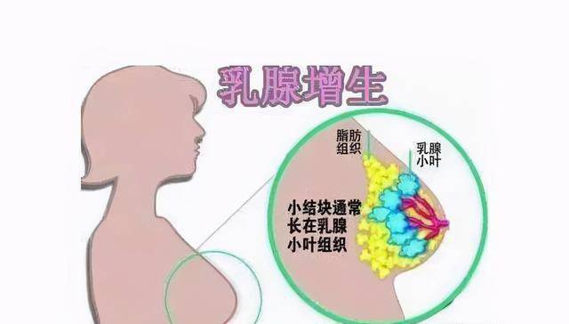 36岁女子摸到胸部疙瘩查出乳腺癌