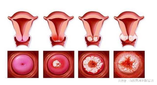 从HPV感染到宫颈癌只有5步