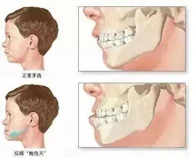 森碟下巴后缩疑错过最佳矫正期